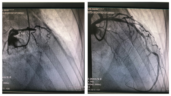 术前：造影显示LAD近段闭塞，有大量血栓，TIMI血流0级。术后：造影显示LAD近段狭窄40％，血流TIMI3级。抽出大量血栓，患者疼痛明显缓解。.jpg